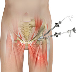 Hip Arthroscopy