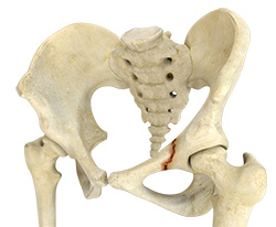 Hip Fracture