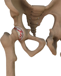 Inflammatory Arthritis of the Hip