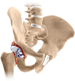 Revision Hip Replacement